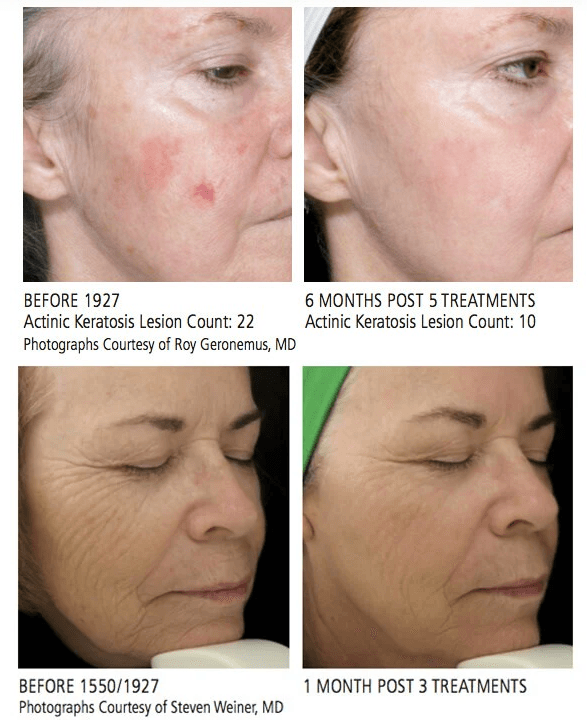 Fraxel Laser